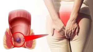 Piles Treatment