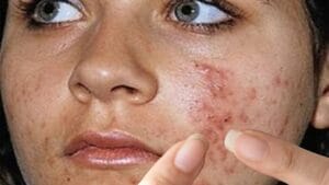 Remedies for Pimples