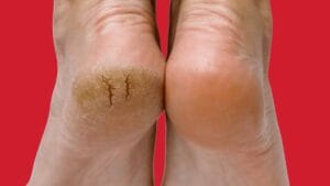Cracked Heels Remedies