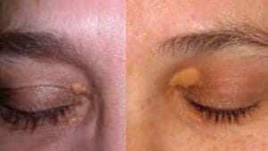Spot in Eye Corner
