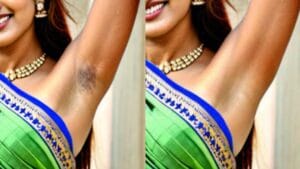 Underarms Dark Spot